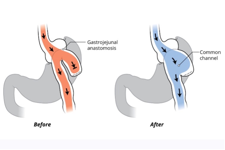 Illustration of the new endoscopic procedure by AdventHealth gastroenterologist Kamibiz Kadkhodayan, MD
